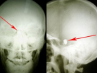Молдавские врачи извлекли из мозга человека пулю, остававшуюся там 1,5 года