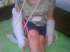 Первоклассник сломал обе руки и нос в жутком падении с лестницы в Слободзее