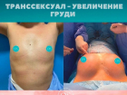 Молдавский хирург увеличила груди транссексуалов