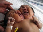 Младенца с двумя головами, родившегося в Индии, показали на видео