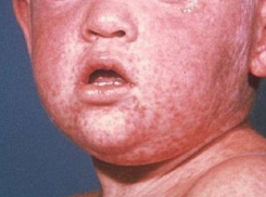 Первая жертва кори в Молдове: семимесячный мальчик привез болезнь из Украины