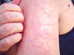 В Молдове отмечается вспышка кори