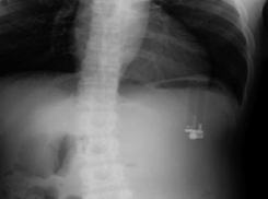 Газовую зажигалку обнаружили врачи в желудке американца 