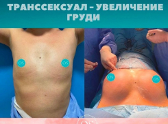 Молдавский хирург увеличила груди транссексуалов