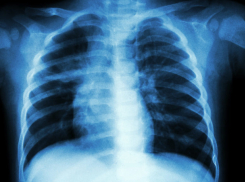 В Кишиневе бушует пневмония: сильнее остальных страдают дети