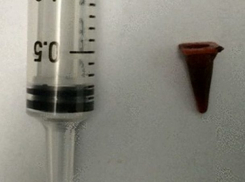 Вместо раковой опухоли хирурги извлекли игрушку из легких пациента 