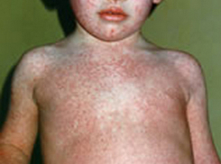 Страшную статистику эпидемии кори озвучили на Украине: зараза в первую очередь косит детей