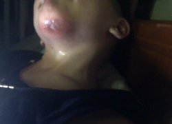 В Бендерах ребенок провалился в канализацию и разбил лицо