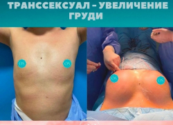 Молдавский хирург увеличила груди транссексуалов
