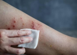 Оспа обезьян в Молдове: заболел приехавший из США 