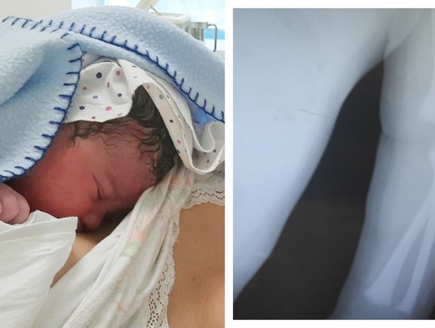 Пара из Бельц обвиняет врачей в халатности: их ребенок родился со сломанной рукой