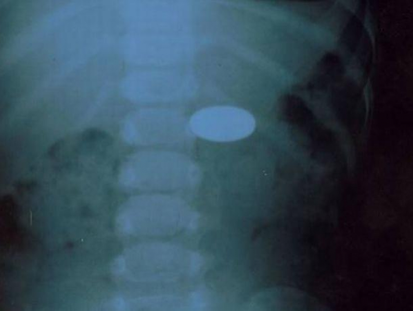 Срочно - 2-летняя девочка госпитализирована из-за проглоченной монеты достоинством в 1 лей