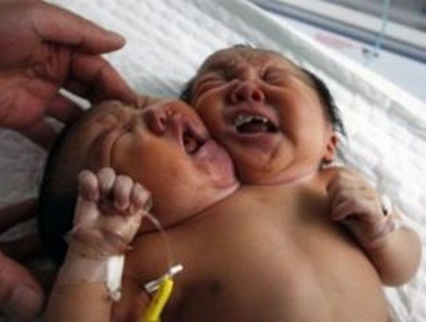 Младенца с двумя головами, родившегося в Индии, показали на видео