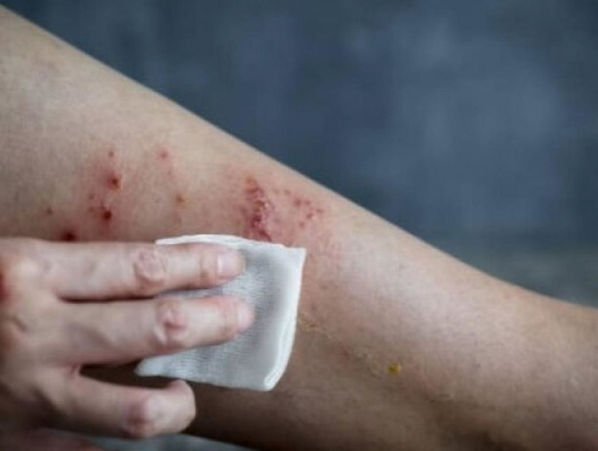 Оспа обезьян в Молдове: заболел приехавший из США 