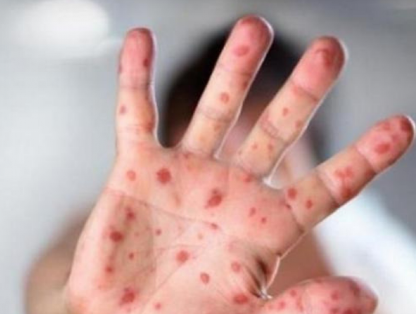 Маленький ребенок привез в Молдову корь из путешествия на Украину